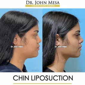 Bild von Dr. John Mesa, MD: Plastic Surgeon NYC, Buccal Fat Removal, Chin Liposuction, Facelift, Facial Masculinization, Chin Implant