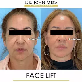 Bild von Dr. John Mesa, MD: Plastic Surgeon NYC, Buccal Fat Removal, Chin Liposuction, Facelift, Facial Masculinization, Chin Implant