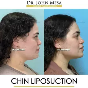 Bild von Dr. John Mesa, MD: Plastic Surgeon NYC, Buccal Fat Removal, Chin Liposuction, Facelift, Facial Masculinization, Chin Implant