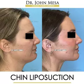 Bild von Dr. John Mesa, MD: Plastic Surgeon NYC, Buccal Fat Removal, Chin Liposuction, Facelift, Facial Masculinization, Chin Implant