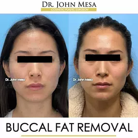 Bild von Dr. John Mesa, MD: Plastic Surgeon NYC, Buccal Fat Removal, Chin Liposuction, Facelift, Facial Masculinization, Chin Implant