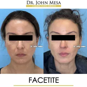 Bild von Dr. John Mesa, MD: Plastic Surgeon NYC, Buccal Fat Removal, Chin Liposuction, Facelift, Facial Masculinization, Chin Implant