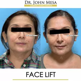 Bild von Dr. John Mesa, MD: Plastic Surgeon NYC, Buccal Fat Removal, Chin Liposuction, Facelift, Facial Masculinization, Chin Implant