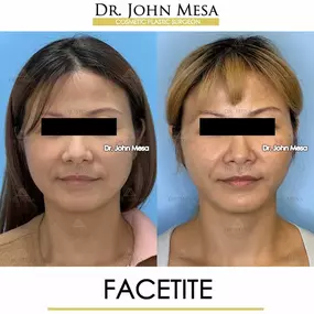 Bild von Dr. John Mesa, MD: Plastic Surgeon NYC, Buccal Fat Removal, Chin Liposuction, Facelift, Facial Masculinization, Chin Implant