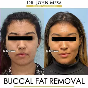 Bild von Dr. John Mesa, MD: Plastic Surgeon NYC, Buccal Fat Removal, Chin Liposuction, Facelift, Facial Masculinization, Chin Implant