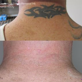 Before and After Tattoo Removal on Back of Neck