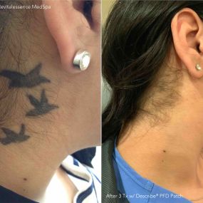 Before and After Tattoo Removal on Neck