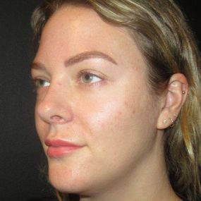 Microneedling Results