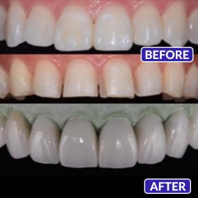 Smile Design Dentistry & Implant Center - veneers