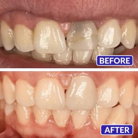 Smile Design Dentistry & Implant Center - Single Crown