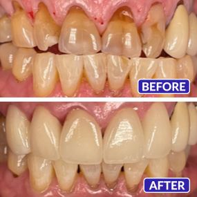 Smile Design Dentistry & Implant Center - Multi-Crowns