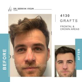 Before After result - Dr Serkan Aygin Clinic