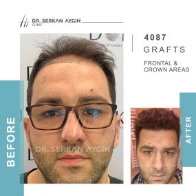 Before After result - Dr Serkan Aygin Clinic