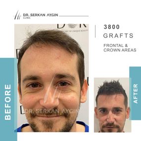 Before After result - Dr Serkan Aygin Clinic