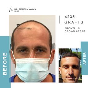 Bild von Hair Transplant Turkey | Dr. Serkan Aygin | London Branch Office