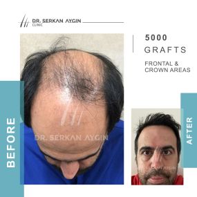 Before After result - Dr Serkan Aygin Clinic