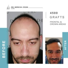 Bild von Hair Transplant Turkey | Dr. Serkan Aygin | London Branch Office