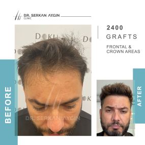 Before After result - Dr Serkan Aygin Clinic