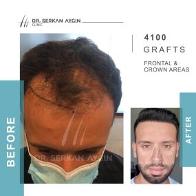 Before After result - Dr Serkan Aygin Clinic