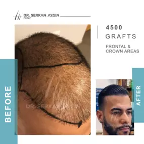 Bild von Hair Transplant Turkey | Dr. Serkan Aygin | London Branch Office