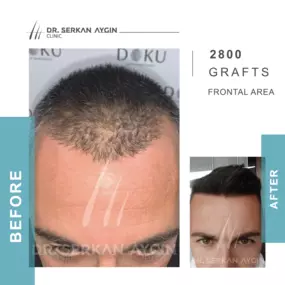 Bild von Hair Transplant Turkey | Dr. Serkan Aygin | London Branch Office