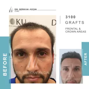 Bild von Hair Transplant Turkey | Dr. Serkan Aygin | London Branch Office