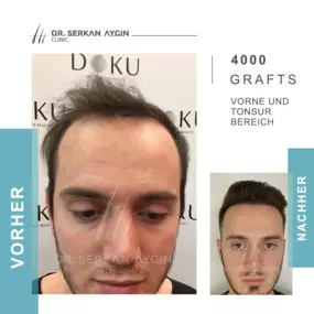 Before After result - Dr Serkan Aygin Clinic