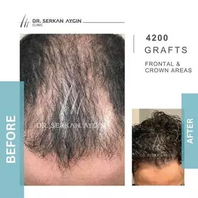 Bild von Hair Transplant Turkey | Dr. Serkan Aygin | London Branch Office