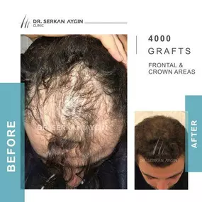 Bild von Hair Transplant Turkey | Dr. Serkan Aygin | London Branch Office