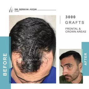 Bild von Hair Transplant Turkey | Dr. Serkan Aygin | London Branch Office