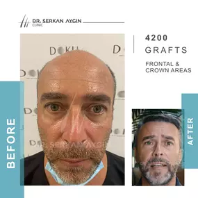 Before After result - Dr Serkan Aygin Clinic