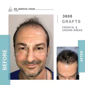 Bild von Hair Transplant Turkey | Dr. Serkan Aygin | London Branch Office