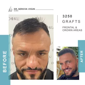 Before After result - Dr Serkan Aygin Clinic