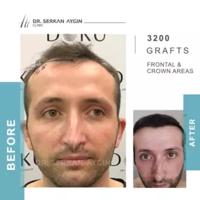 Before After result - Dr Serkan Aygin Clinic