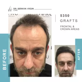 Bild von Hair Transplant Turkey | Dr. Serkan Aygin | London Branch Office