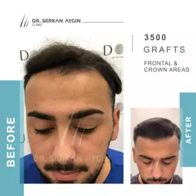 Before After result - Dr Serkan Aygin Clinic