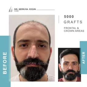 Before After result - Dr Serkan Aygin Clinic