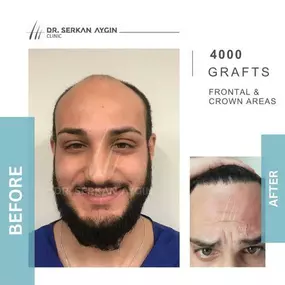 Bild von Hair Transplant Turkey | Dr. Serkan Aygin | London Branch Office