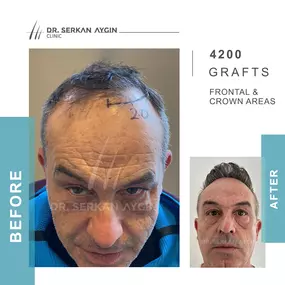 Before After result - Dr Serkan Aygin Clinic