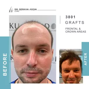 Before After result - Dr Serkan Aygin Clinic