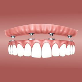 Bild von Trevisani Oral Surgery & Dental Implants