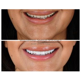 Veneers at Wilshire Smile Studio