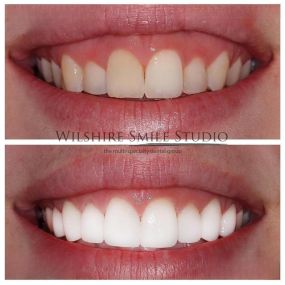 Veneers at Wilshire Smile Studio