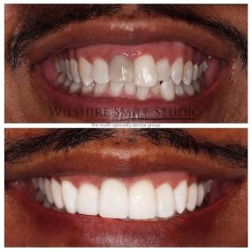 Veneers at Wilshire Smile Studio