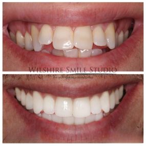 Veneers at Wilshire Smile Studio