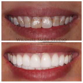 Veneers at Wilshire Smile Studio