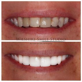 Veneers at Wilshire Smile Studio