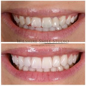 Veneers at Wilshire Smile Studio