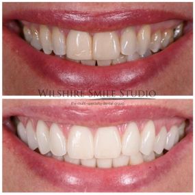 Veneers at Wilshire Smile Studio