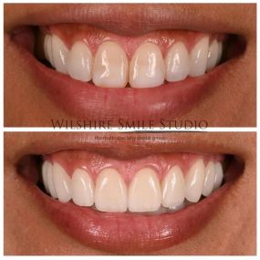 Veneers at Wilshire Smile Studio